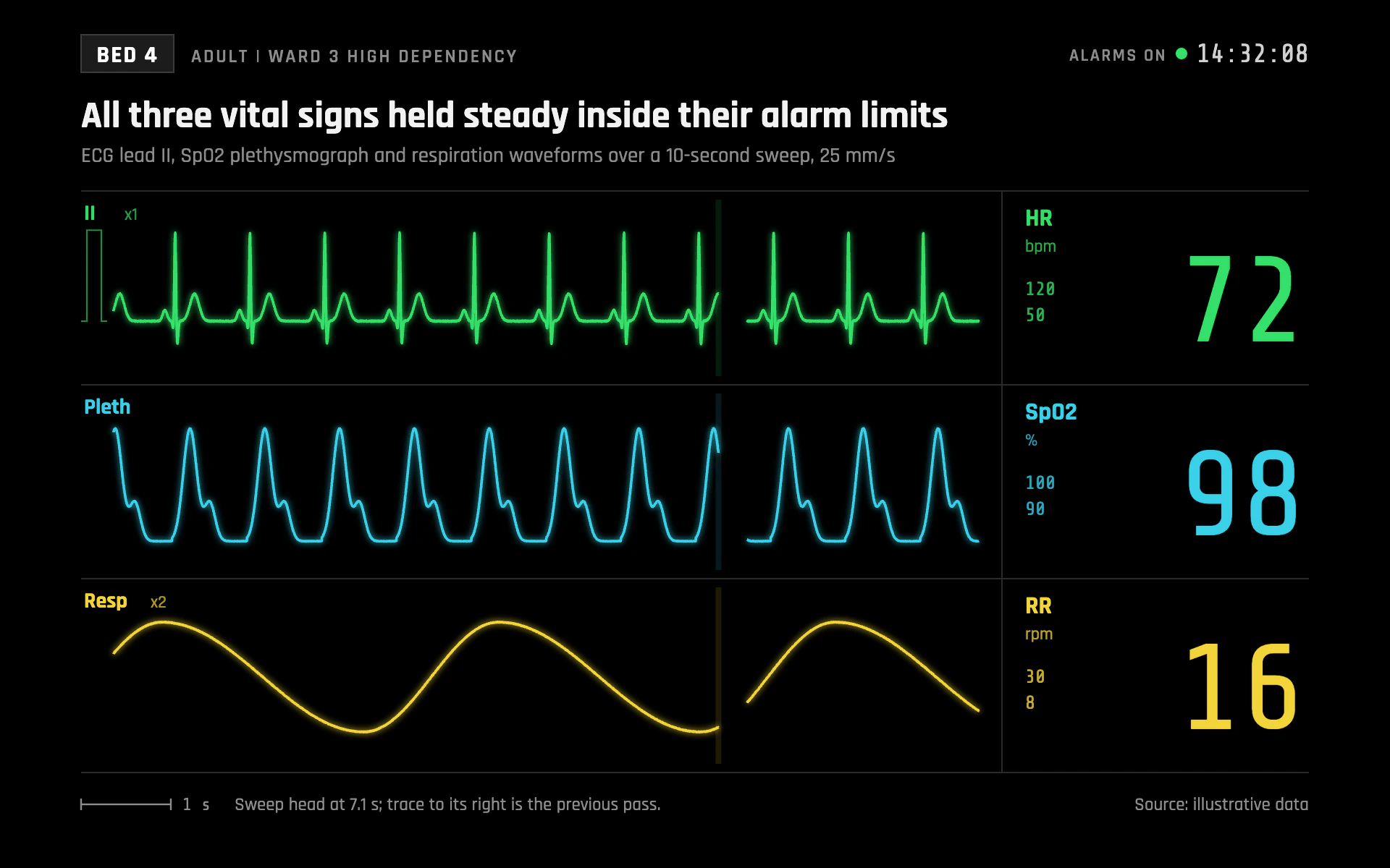 Bedside Monitor line chart, dark theme: A black patient monitor with sweep-style vital sign lanes and big readouts.