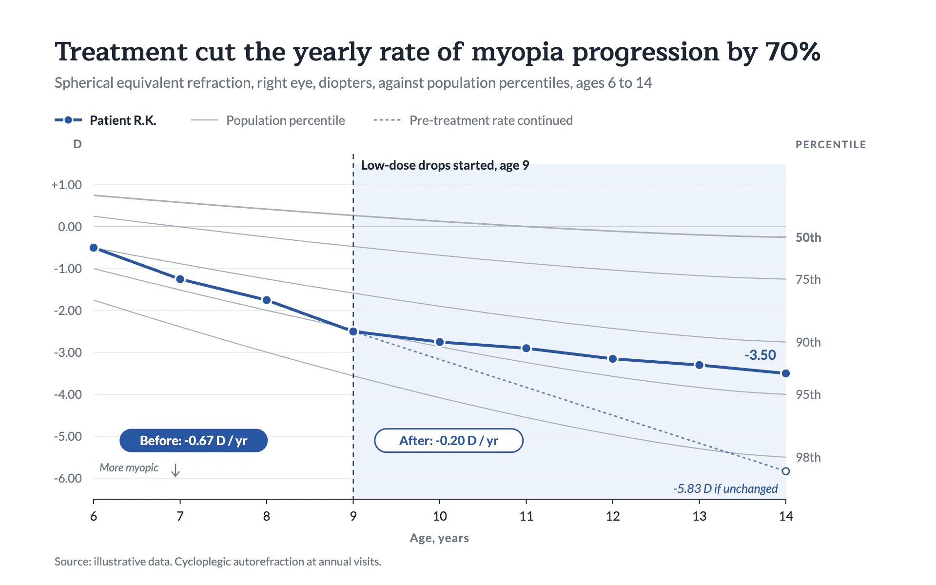 Myopia Progression line chart, light theme: Clinical growth chart with gray percentile curves and one bold blue patient line.