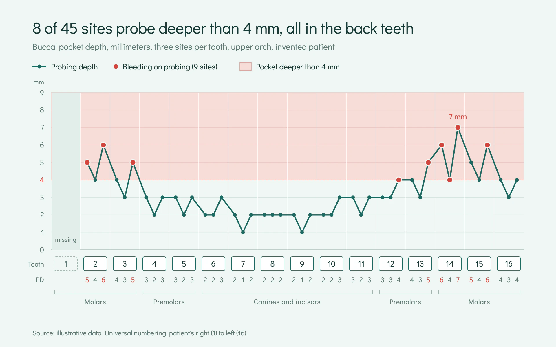 Periodontal Chart line chart, light theme: Mint perio record with a teal depth line, red bleeding dots and boxed tooth numbers.